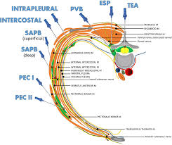 Image result for Intrapleural Anesthesia