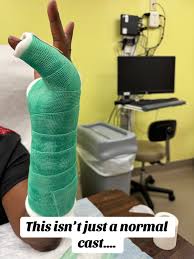 Image result for Ulnar Gutter Cast