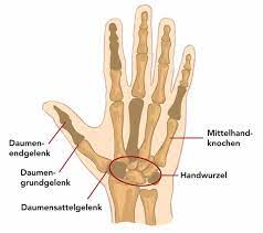 Vorsicht ist geboten, wenn eine schiene getragen wird: Handschmerzen Ursache Behandlung Und Top Ubungen Liebscher Bracht