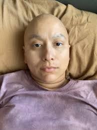 Hip Disarticulation Amputee Guy