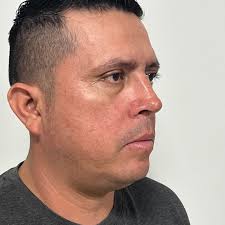 Dr. Rene Pacheco ORL/CIRUJANO PLASTICO FACIAL Post quirúrgico un mes de  evolución, Rinoplastia masculina. Resultados naturales, manteniendo líneas  estéticas armónicas y adecuadas. Turnos para video llamada o presenciales  al los números: 0995090978. #