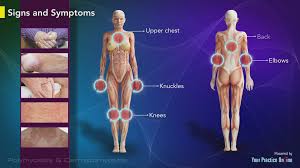 Image result for Polymyositis