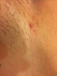 Check spelling or type a new query. Is This An Ingrown Hair Or What Down There Glow Community