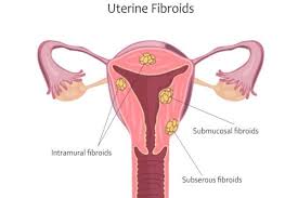 The result has been the normalizing of my bp, no spikes and feeling better than i have in years. Uterine Fibroid The Treatments You Need To Know About Thehealthsite Com