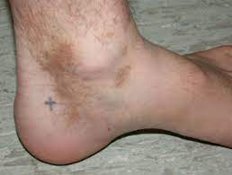 Purpura is caused by spontaneous leaking of blood from tiny blood vessels (capillaries). Capillaritis Dermnet Nz