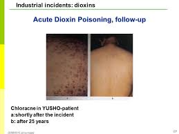 Dioxin poisoning encompasses toxic effects of acute and chronic exposure to one or more of dioxin poisoning: Acute And Chronic Dioxin Poisoning Ppt Download