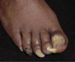 Image result for Onychogryphosis feet