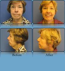 Pin On Richmond Surgical Arts Cosmetic Surgery
