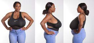 Biggest Natural Breasts in Texas - Woman has 36JJJ Breast Reduction