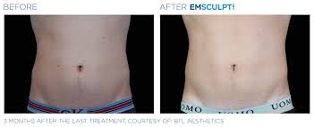 Train your abs three times per week with this quick routine at the end of your workouts: Emsculpt Neo Binhlam Aesthetics Nashville Tn