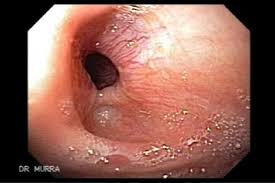 In such cases patient complains for food deglutition problem which is due to narrowing of. Plummer Vinson Syndrome The Gastrointestinalatlas Gastrointestinalatlas Com