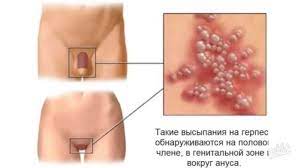 Herpes se lako prenosi fizičkim kontaktom sa zaraženom osobom. Kako Pobijediti Genitalni Herpes Ucinkovit Tretman Za Genitalni Herpes Moze Li Kondom Sprijeciti Prijenos Genitalnog Herpesa