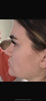Rhinoplasty in Turkey