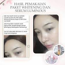 Ketika pemakaian awal dari ms glow ultimate ini anda mungkin akan merasakan rasa perih atau pengelupasan ms glow. Paket Ms Glow Whitening Series Paket Whitening Ms Glow Shopee Indonesia