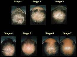 They are mainly from the it sector. Hair Loss Explained How And Why Men Go Bald The Independent The Independent