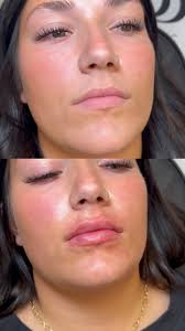 botox #bbaesthetic #daisies #justinbieber #instagram #ohio #cincinnati