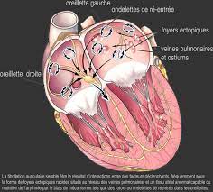 La maladie, diagnostic, quels patients traiter ?, objectifs de la prise en charge, prise en charge, traitements. Ablation De La Fibrillation Auriculaire Par Radiofrequence La Sante Est Une Ressource De La Vie Quotidienne