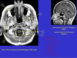 Mri Brain Anatomy Dr Muhammad Bin Zulfiqar