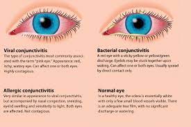 How To Avoid "Pink Eye" (Conjunctivitis) - Thomas Eye Center