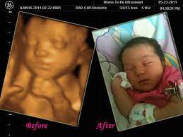You learn today about your baby development, prenatal care (doctor visits) and fetal ultrasound at 31 weeks. Before And After 3d Ultrasound Images