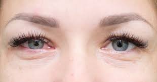 Maybe you would like to learn more about one of these? Swollen Eyes Dark Circles Red And Burning Eyes
