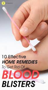 What is the best treatment for a tiny blood blister on corner of lower lip? Shannen Heyman Shannenheyman Profile Pinterest