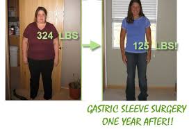 Gastric Sleeve Surgery Sleeve Surgery Gastric Sleeve Surgery Gastric Sleeve