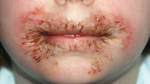 Image result for dermatitis contacta children
