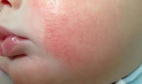 прыщи на подбородке у женщин какой орган не впорядке Kozha Zerkalo Organizma O Pryshavoj Probleme V Intervyu S Dermatovenerologom Andreem Garmonovym Tia