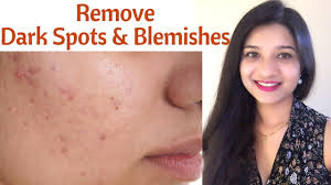 The appearance of uneven skin tone on the face, chest, and hands are a clear sign of aging skin, but we'll point you with the right mix of products, you really can get your youthful glow back! Remove Acne Spots Dark Spots Blemishes In Hindi 100 Natural Face Mask To Get Even Skin Tone Youtube