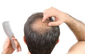 Giovanile è affetta da calvizie più o meno gravi già a partire tra i 12 e i 20 anni. Quanti Capelli Si Perdono Al Giorno