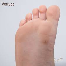 Image result for verruca