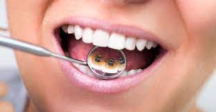 The fourth inner brace is courage. Lingual Braces Pros And Cons Cost Comfort Lisping And More
