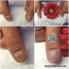 8 6 2016 Tarihli Tirnak Yatagi Bozukluguna Bagli Bozuk Tirnakta Medikal Protez Tirnak Uygulamasi Ile Giderilmesi Medikal Protez Tirnak Uygulamasi Tirnak Tirnak