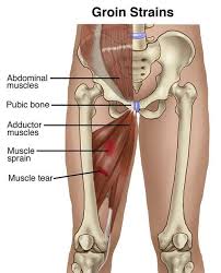 Simplified diagram of groin anatomy. Pin On Symptoms And Conditions
