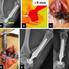 Swansonvitamins.com is an online service of swanson health products, helping our customers stay healthy since 1969! Pdf Thumb Cmc Total Exchange Arthroplasty With The Arpe Implant