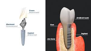 Image result for dental implant