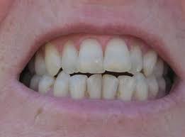 Does Regenerate Toothpaste Really Work To Rebuild Enamel And Repair Tooth Enamel Erosion Tooth Enamel Chipped Tooth Repair Tooth Repair