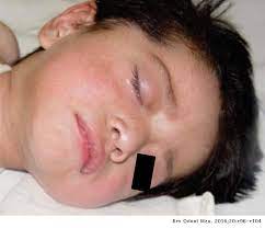 Battered Child Syndrome With Stomatological Repercussions Case Report Revista Odontologica Mexicana