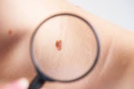 Anyone can develop skin cancer but you're particularly at risk if you have fair skin, lots of moles or freckles, red or fair hair, pale coloured eyes, used tanning beds, a family history of skin cancer or had skin cancer before, or take medication it's one of the most common types of cancer in the world. Signs Of Skin Cancer And Prevention For Adults And Kids Cone Health