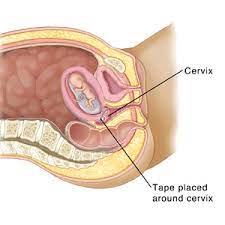 Maybe you would like to learn more about one of these? Pregnancy And Childbirth Abdominal Cerclage Saint Luke S Health System