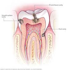 When searching for a cavity on a tooth, a dentist looks for any sign on the radiograph that indicates or suggests that the density of any portion of the tooth's hard calcified tissues (enamel and/or dentin) is different than normal or expected. Cavities Tooth Decay Symptoms And Causes Mayo Clinic