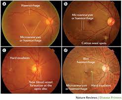 This is because diabetes can lead to eye problems, such as diabetic retinopathy. Diabetic Retinopathy Nature Reviews Disease Primers