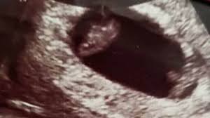 The journey has officially begun, although a few women might just be discovering and confirming their pregnancy around this. Twin Ultrasound At 6 Weeks Detection Risk About Twins