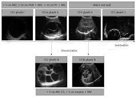 Fluid collection with a split wall fluid collection with septa heterogenous echo patterns. Cystic Echinococcosis Of The Liver A Primer For Hepatologists