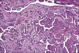 Differential diagnosis includes lymphangioma and malignant cystic mesothelioma. The Peritoneum Clinical Gate
