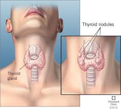 Lymph nodes are evaluated according to the ajcc staging system. Thyroid Nodule Causes Signs Symptoms Diagnosis Treatment