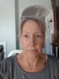 Face-lift & Neck-lift Support Group