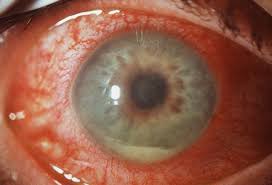 Nevertheless, uveitis is not limited to the uvea. Uveitis Picture Image On Medicinenet Com