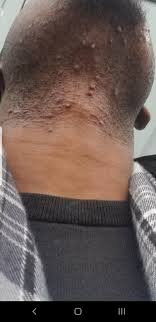 Ingrown hairs can appear in a number of ways. Black Men How To Dealing With Existing Razor Bumps Wicked Edge